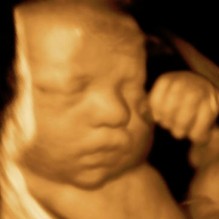 3D Ultrasound 34 weeks