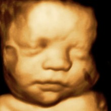 3D Ultrasound 34 weeks