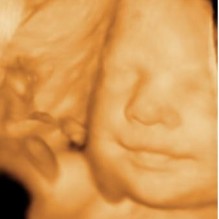 3D Ultrasound