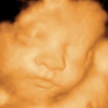 3D Ultrasound