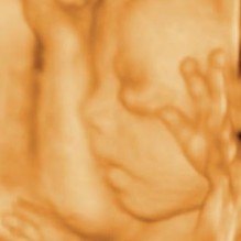 3D Ultrasound
