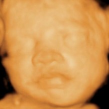 3D Ultrasound