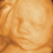 3D Ultrasound