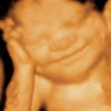 3D Ultrasound