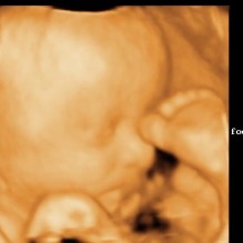 3D Ultrasound