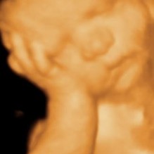 3D Ultrasound