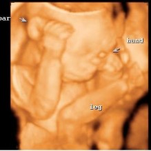 3D Ultrasound