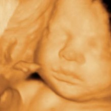 3D Ultrasound