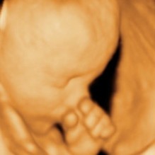 3D Ultrasound