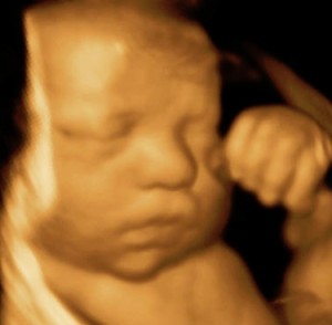 3D Ultrasound 34 weeks