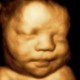 3D Ultrasound 34 weeks