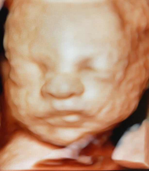 Prenatal Peek Ultrasound Image Prenatal Peek Ultrasound Image