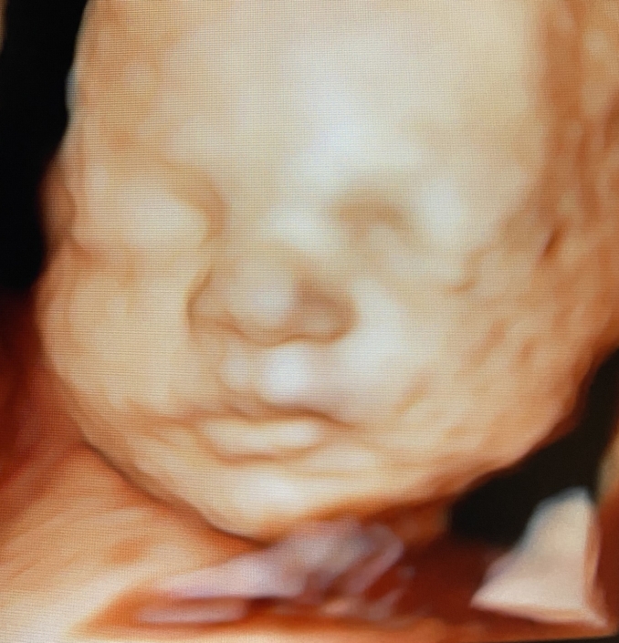 Prenatal Peek Ultrasound Image Prenatal Peek Ultrasound Image