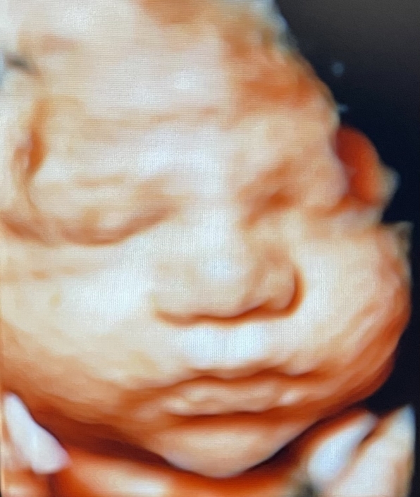 Prenatal Peek Ultrasound Image Prenatal Peek Ultrasound Image