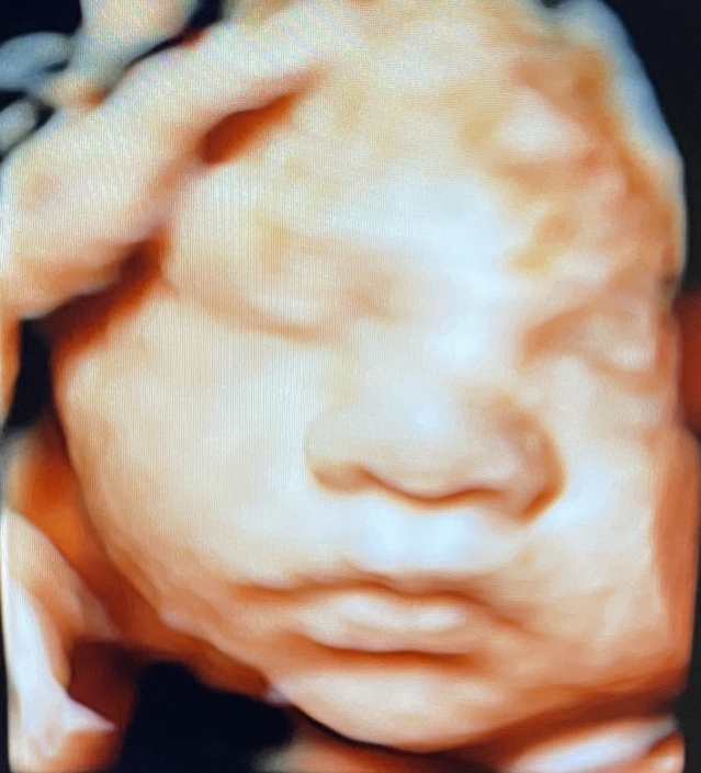 Prenatal Peek Ultrasound Image Prenatal Peek Ultrasound Image