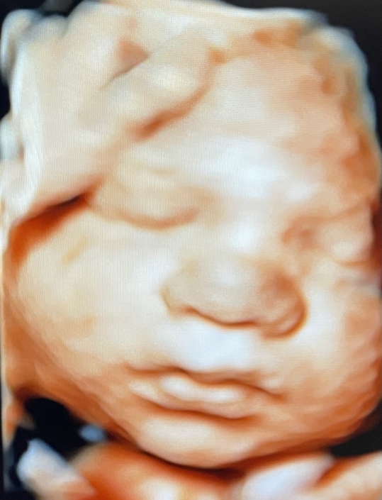 Prenatal Peek Ultrasound Image Prenatal Peek Ultrasound Image