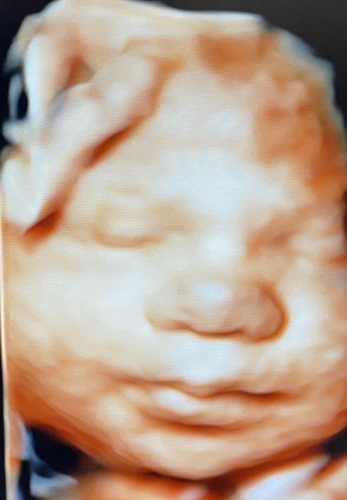 Prenatal Peek Ultrasound Image Prenatal Peek Ultrasound Image
