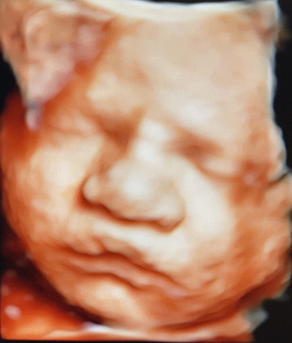 Prenatal Peek Ultrasound Image Prenatal Peek Ultrasound Image