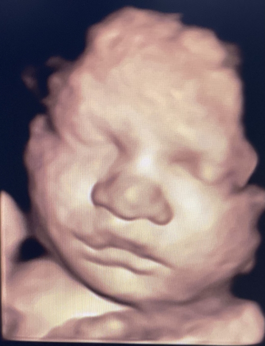 Prenatal Peek Ultrasound Image Prenatal Peek Ultrasound Image