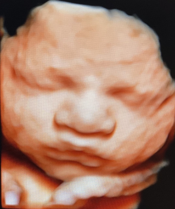 Prenatal Peek Ultrasound Image Prenatal Peek Ultrasound Image