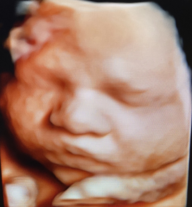 IPrenatal Peek Ultrasound Image Prenatal Peek Ultrasound Image