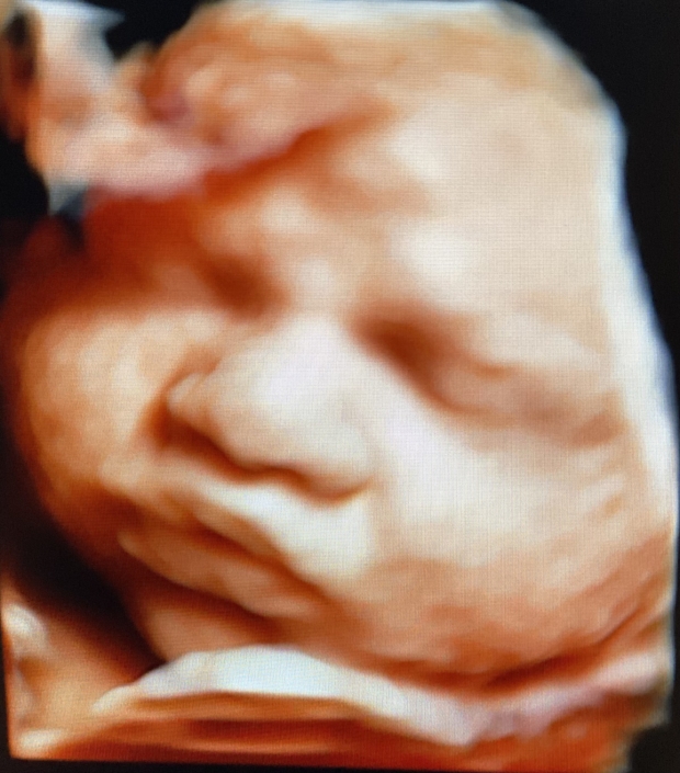 Prenatal Peek Ultrasound Image Prenatal Peek Ultrasound Image