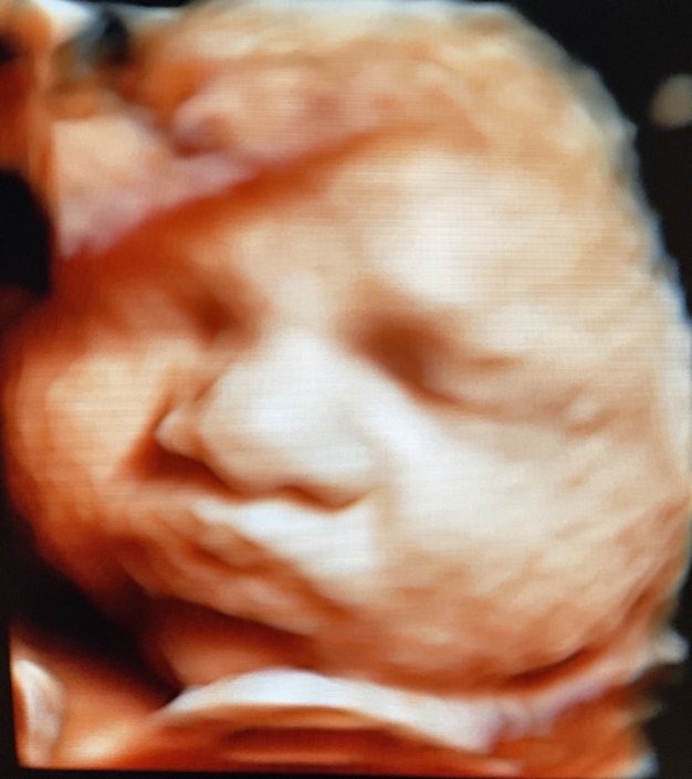 Prenatal Peek Ultrasound Image Prenatal Peek Ultrasound Image