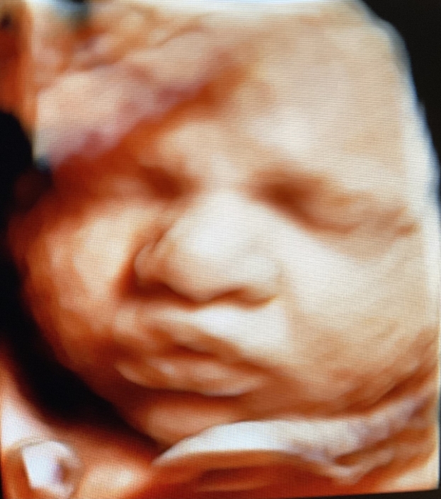 Prenatal Peek Ultrasound Image Prenatal Peek Ultrasound Image