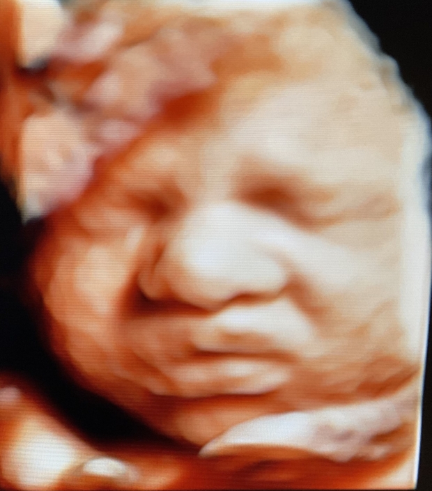 Prenatal Peek Ultrasound Image Prenatal Peek Ultrasound Image