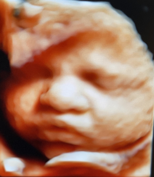 Prenatal Peek Ultrasound Image Prenatal Peek Ultrasound Image