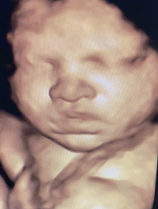 Prenatal Peek Ultrasound Image Prenatal Peek Ultrasound Image