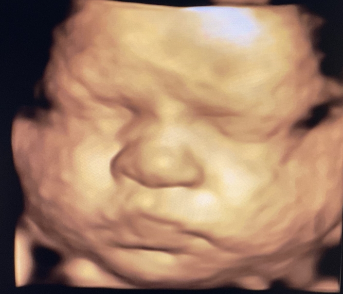 Prenatal Peek Ultrasound Image Prenatal Peek Ultrasound Image