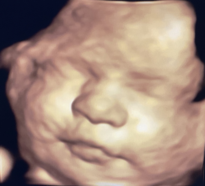 Prenatal Peek Ultrasound Image Prenatal Peek Ultrasound Image