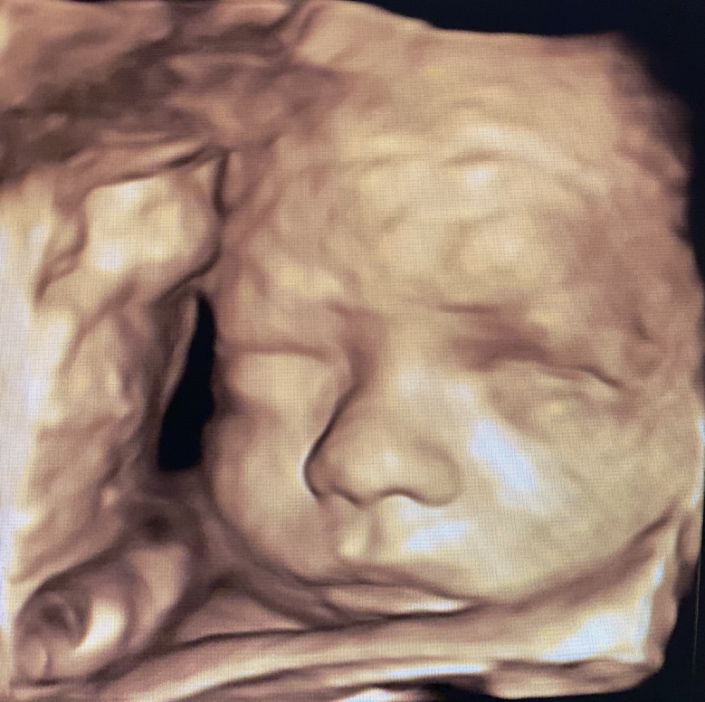 Prenatal Peek Ultrasound Image Prenatal Peek Ultrasound Image