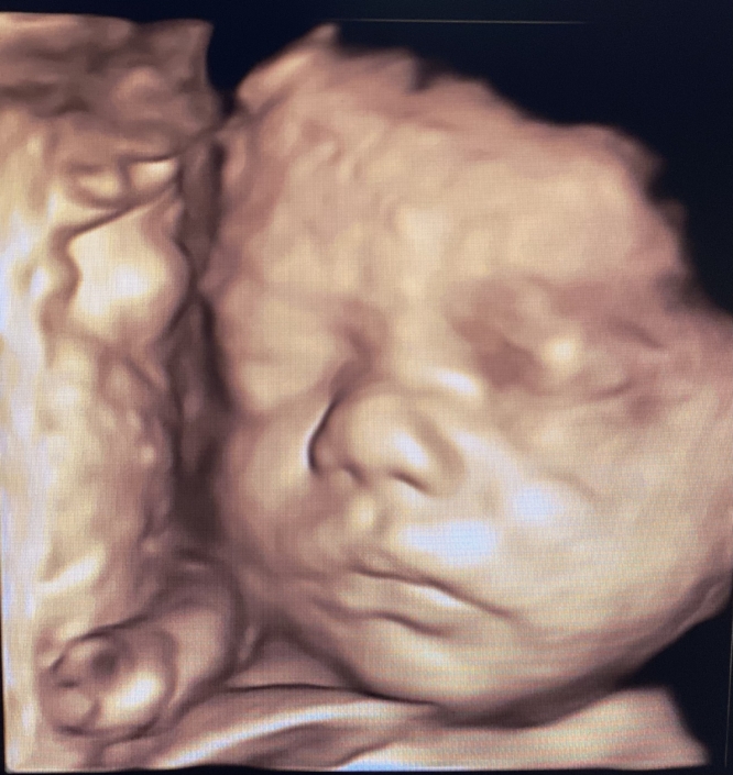 Prenatal Peek Ultrasound Image Prenatal Peek Ultrasound Image
