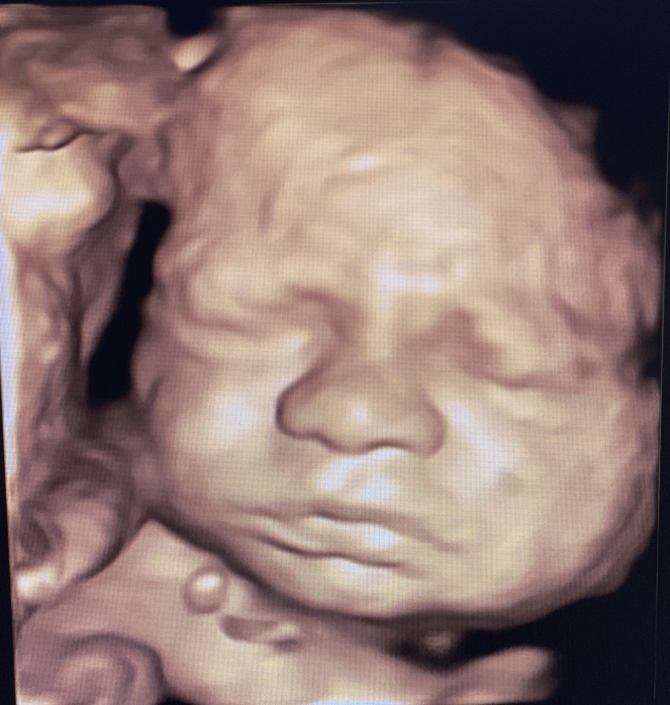 Prenatal Peek Ultrasound Image Prenatal Peek Ultrasound Image