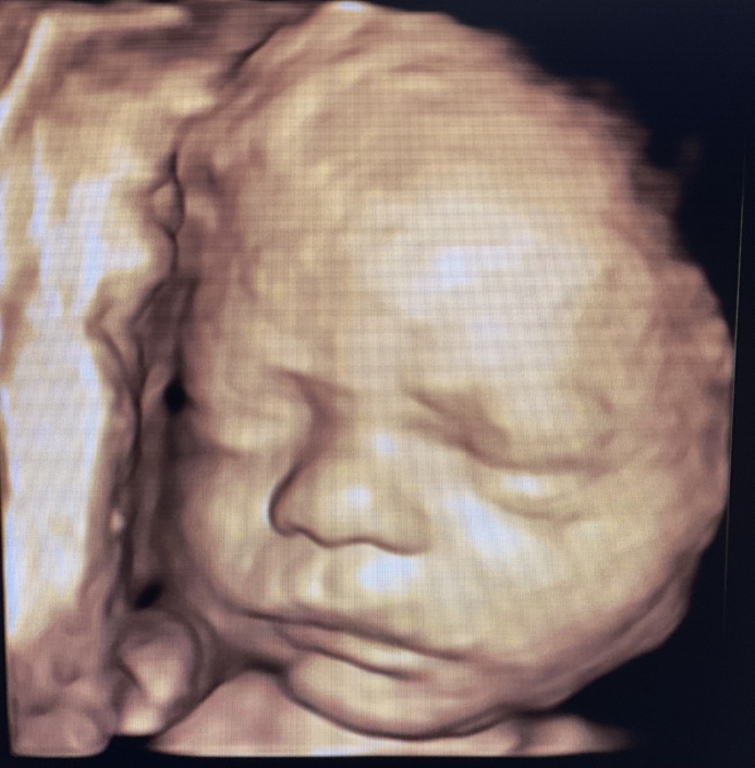 Prenatal Peek Ultrasound Image Prenatal Peek Ultrasound Image
