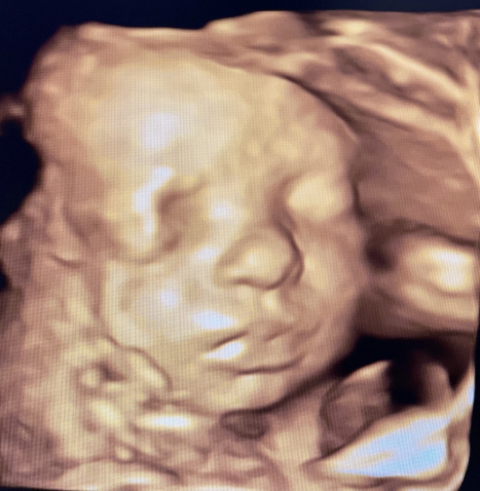 Prenatal Peek Ultrasound Image Prenatal Peek Ultrasound Image
