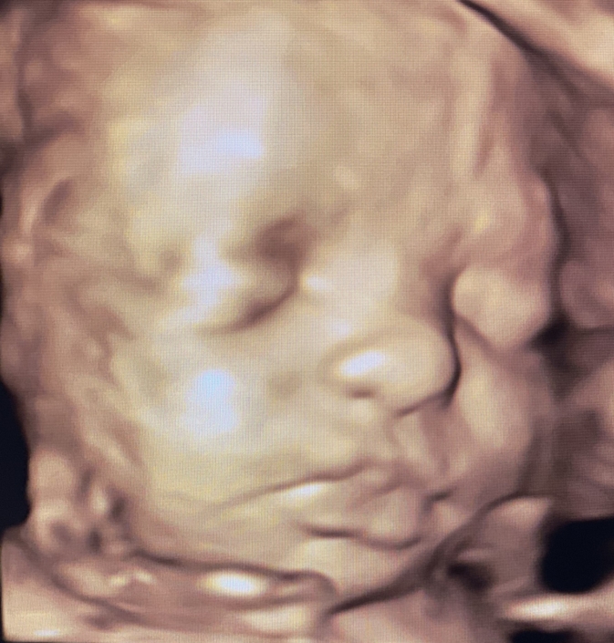 Prenatal Peek Ultrasound Image Prenatal Peek Ultrasound Image